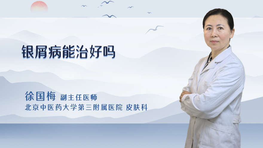 银屑病能治好吗